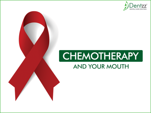 Oral Care During Chemotherapy at Dentzz