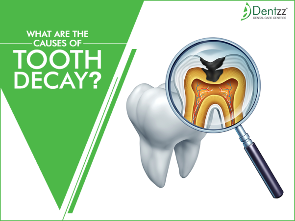 What are the Causes of Tooth Decay
